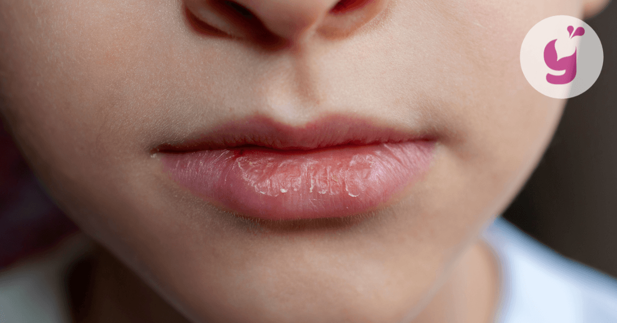 Čo pomáha na suché a popraskané pery u detí a ako im predchádzať